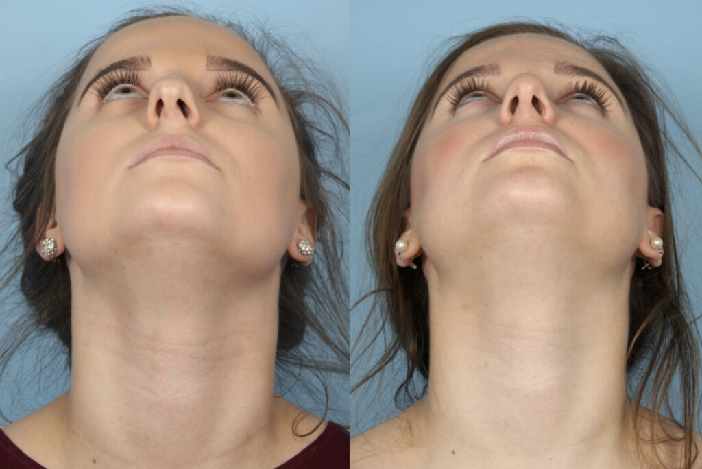Rhinoplasty (Nose Job)