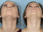 Rhinoplasty (Nose Job)