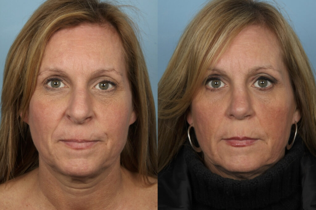 Rhinoplasty (Nose Job)