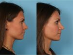 Rhinoplasty (Nose Job)