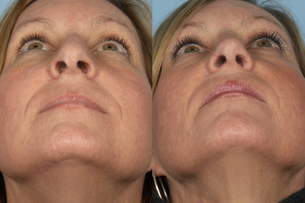 Rhinoplasty (Nose Job)