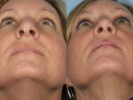 Rhinoplasty (Nose Job)