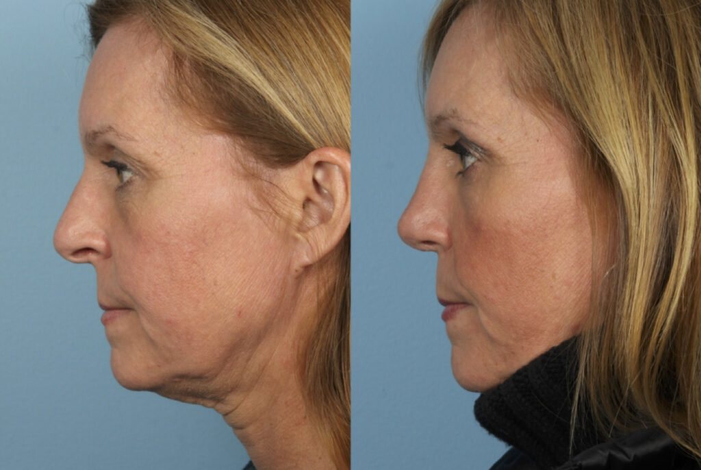 Rhinoplasty (Nose Job)