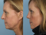 Rhinoplasty (Nose Job)