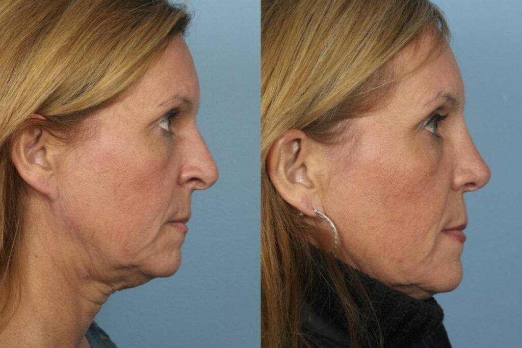 Rhinoplasty (Nose Job)