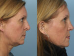 Rhinoplasty (Nose Job)