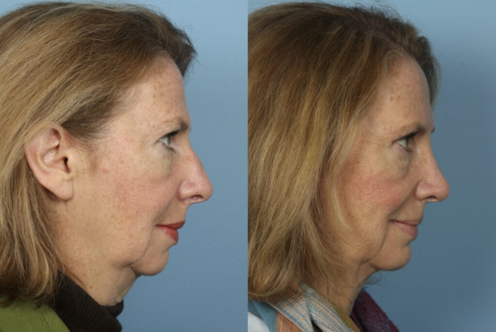 Rhinoplasty (Nose Job)
