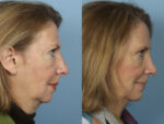 Rhinoplasty (Nose Job)