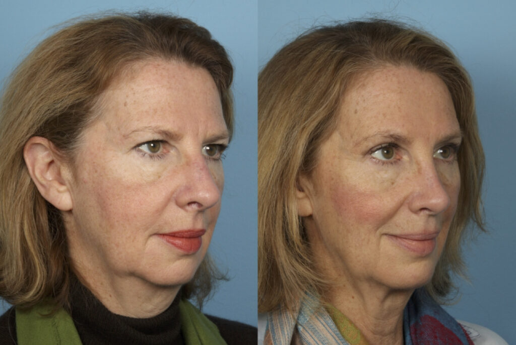 Rhinoplasty (Nose Job)