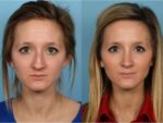 Rhinoplasty (Nose Job)