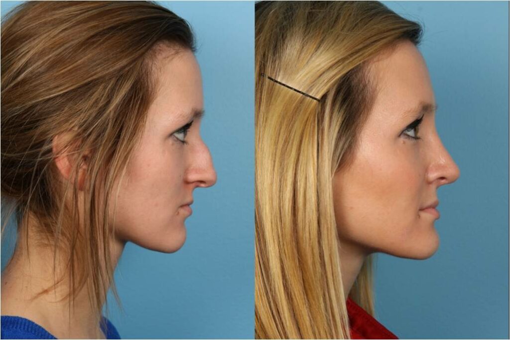 Rhinoplasty (Nose Job)