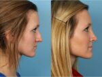 Rhinoplasty (Nose Job)