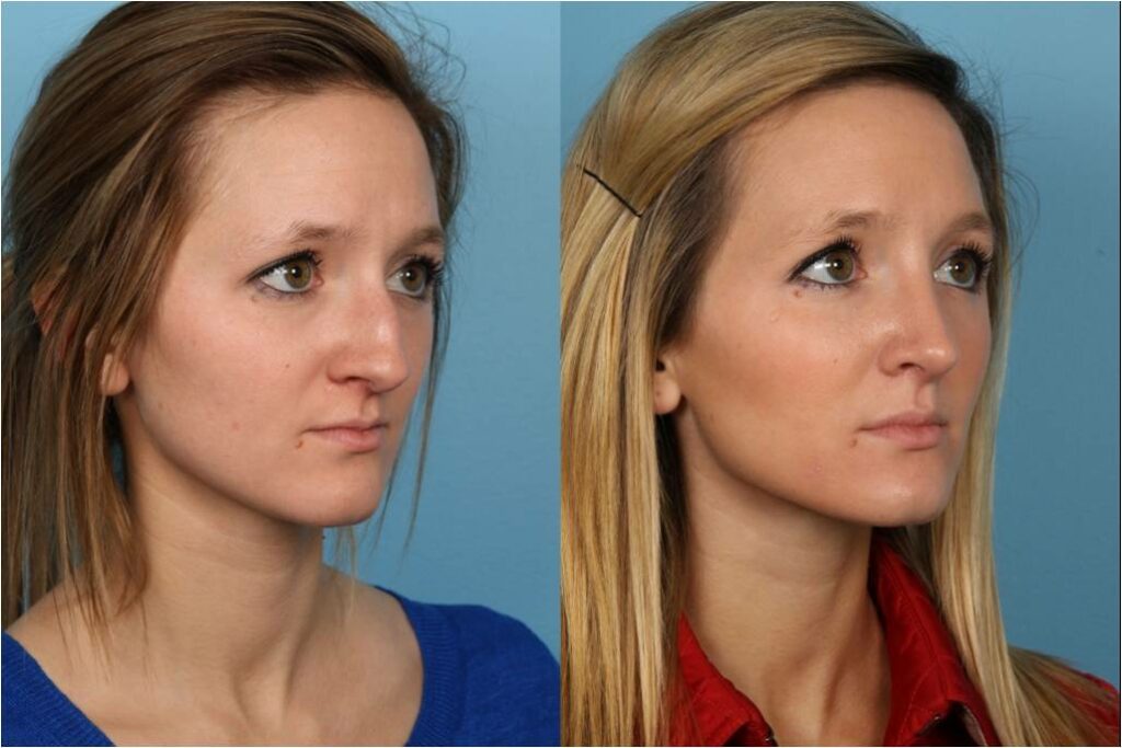 Rhinoplasty (Nose Job)