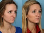 Rhinoplasty (Nose Job)