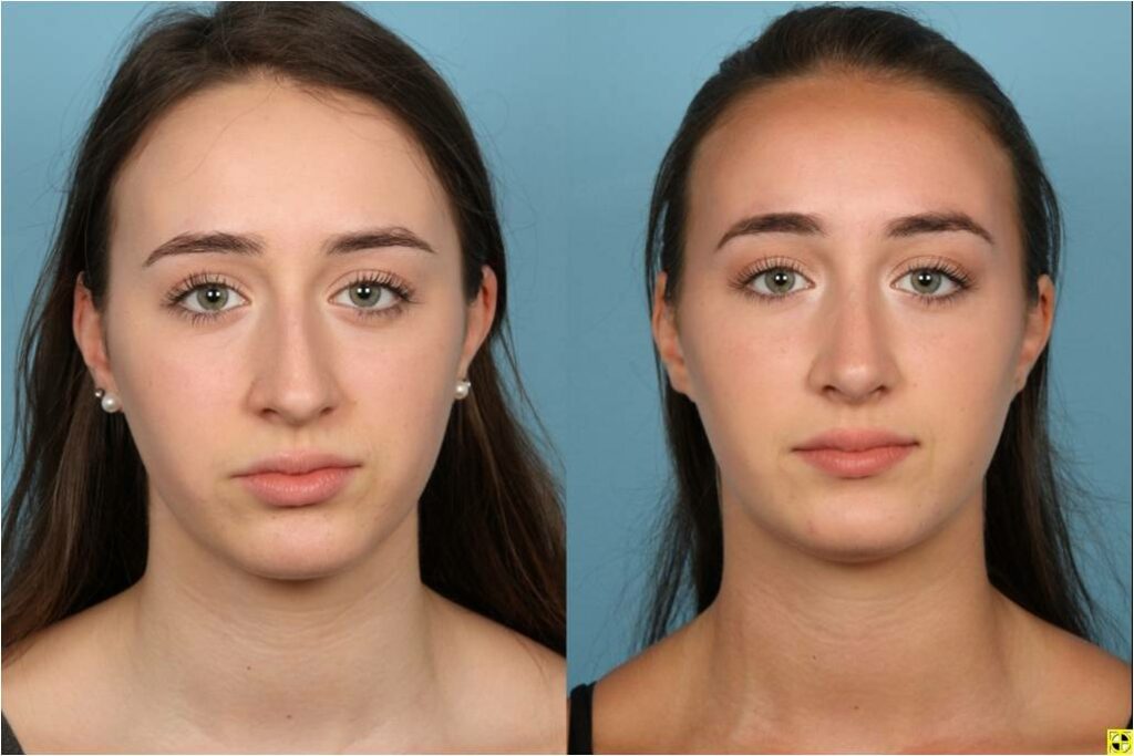 Rhinoplasty (Nose Job)