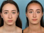 Rhinoplasty (Nose Job)