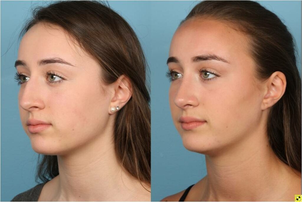 Rhinoplasty (Nose Job)