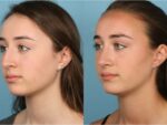 Rhinoplasty (Nose Job)