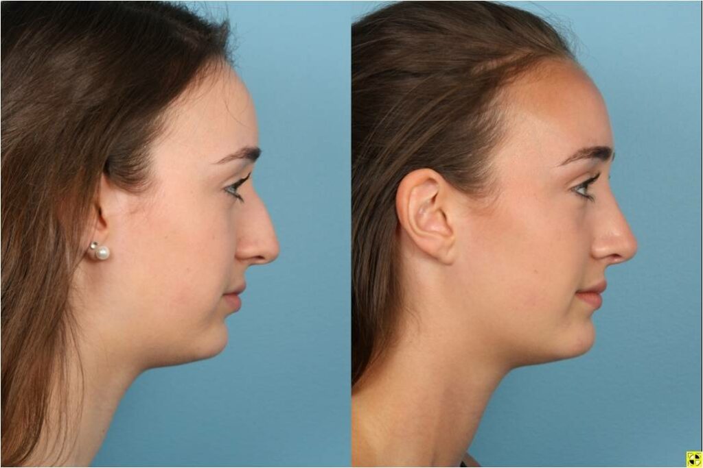 Rhinoplasty (Nose Job)
