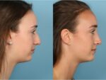 Rhinoplasty (Nose Job)