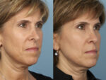 Revision Rhinoplasty