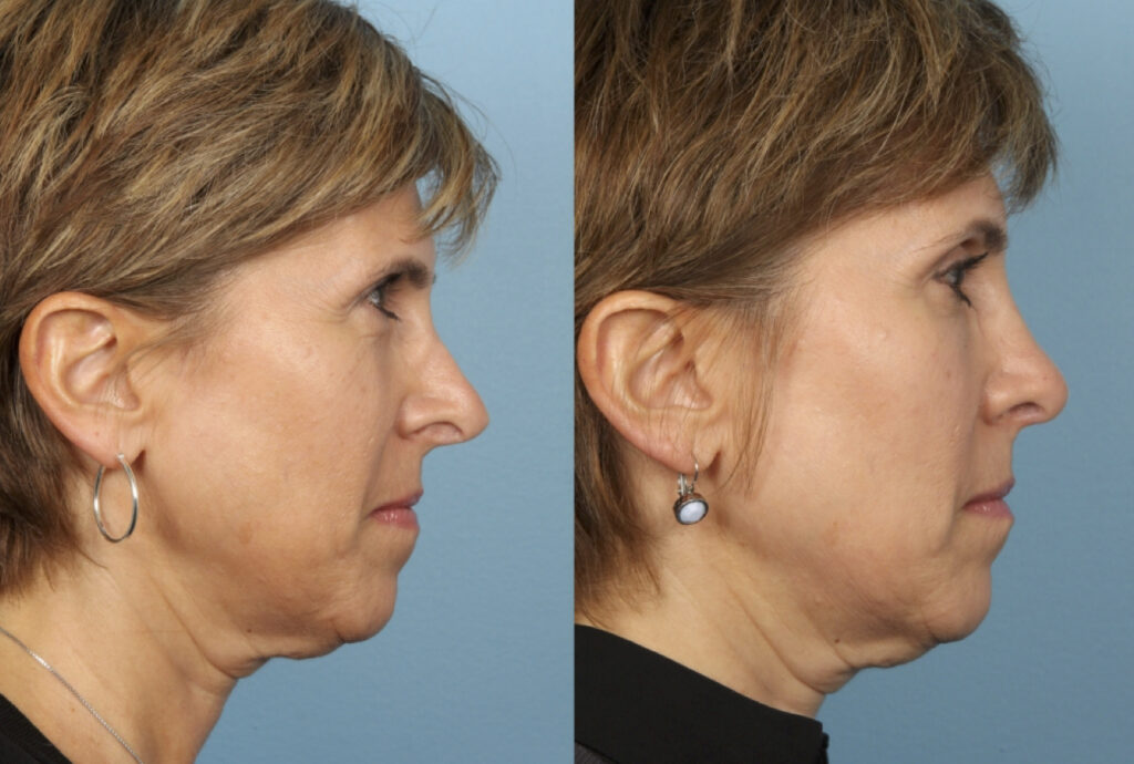 Revision Rhinoplasty