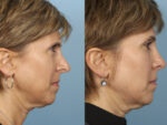 Revision Rhinoplasty