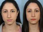 Revision Rhinoplasty