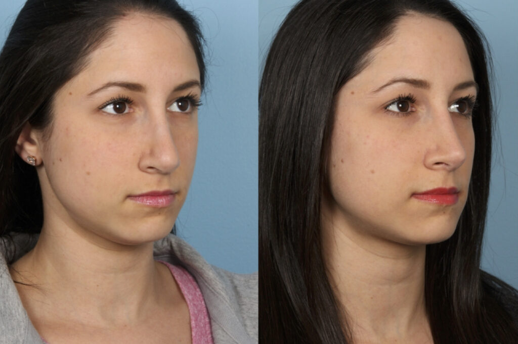 Revision Rhinoplasty
