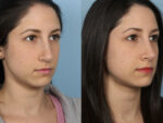 Revision Rhinoplasty