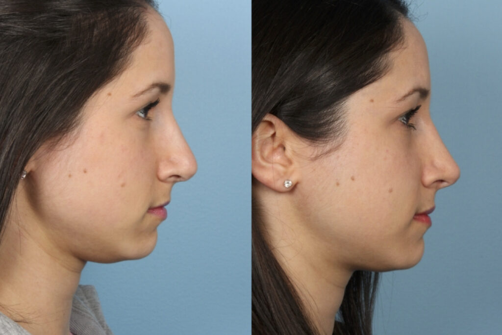 Revision Rhinoplasty