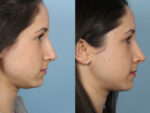 Revision Rhinoplasty