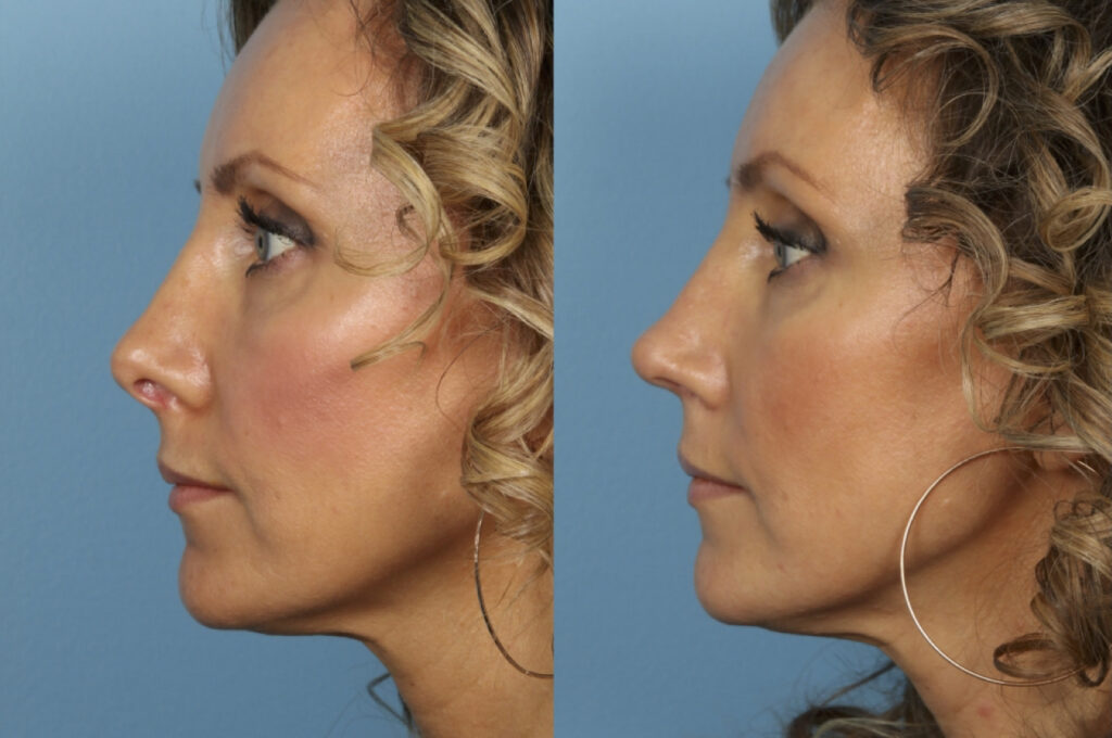 Revision Rhinoplasty