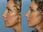 Revision Rhinoplasty