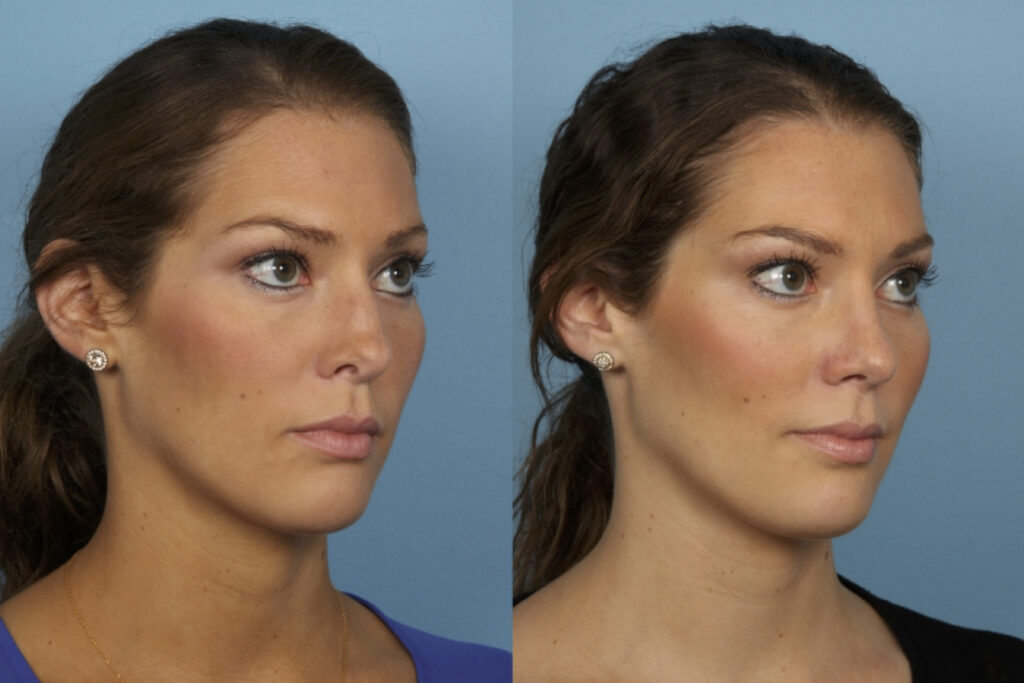 Revision Rhinoplasty