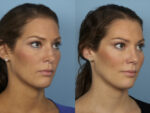 Revision Rhinoplasty