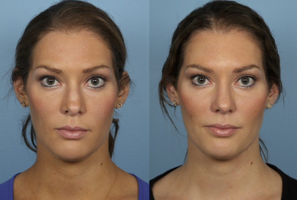 Revision Rhinoplasty