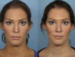 Revision Rhinoplasty