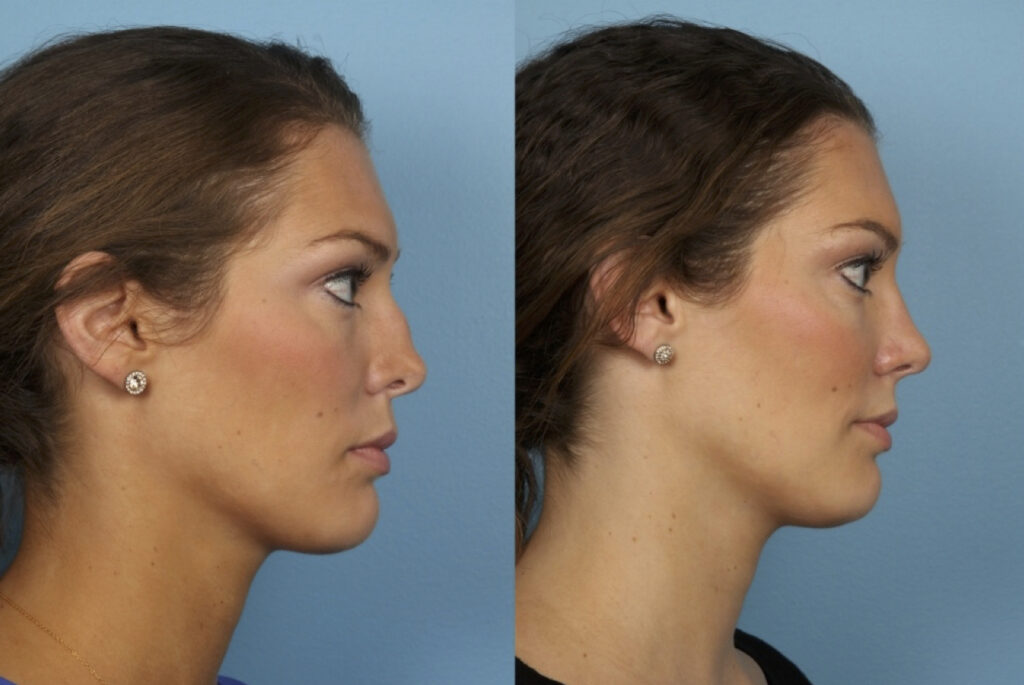 Revision Rhinoplasty