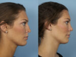 Revision Rhinoplasty