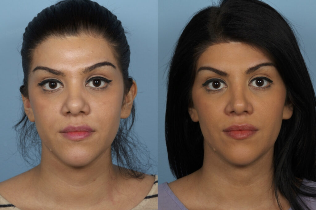 Revision Rhinoplasty