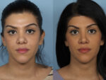 Revision Rhinoplasty