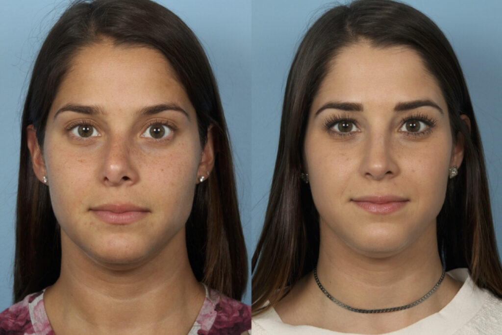 Revision Rhinoplasty
