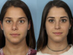 Revision Rhinoplasty