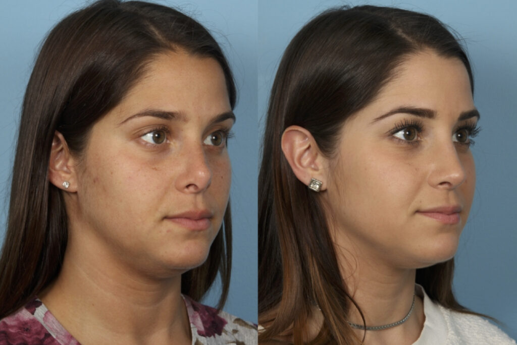 Revision Rhinoplasty