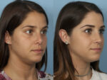 Revision Rhinoplasty