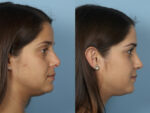 Revision Rhinoplasty