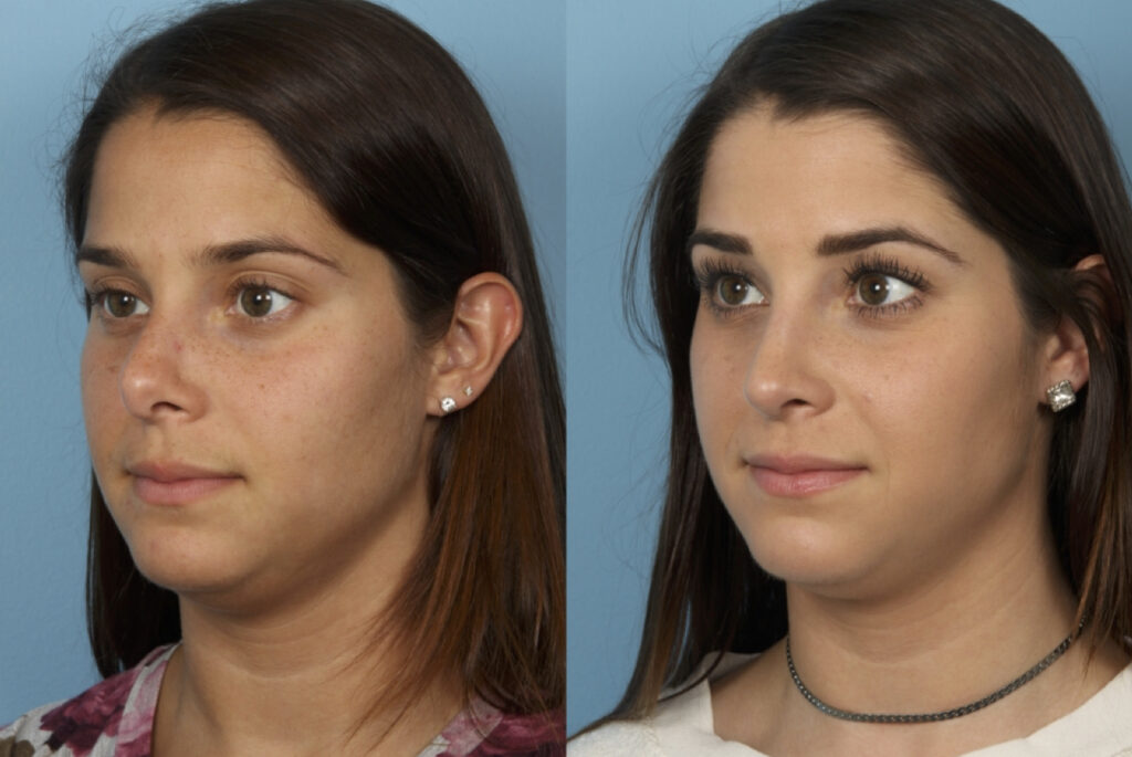 Revision Rhinoplasty
