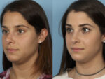 Revision Rhinoplasty