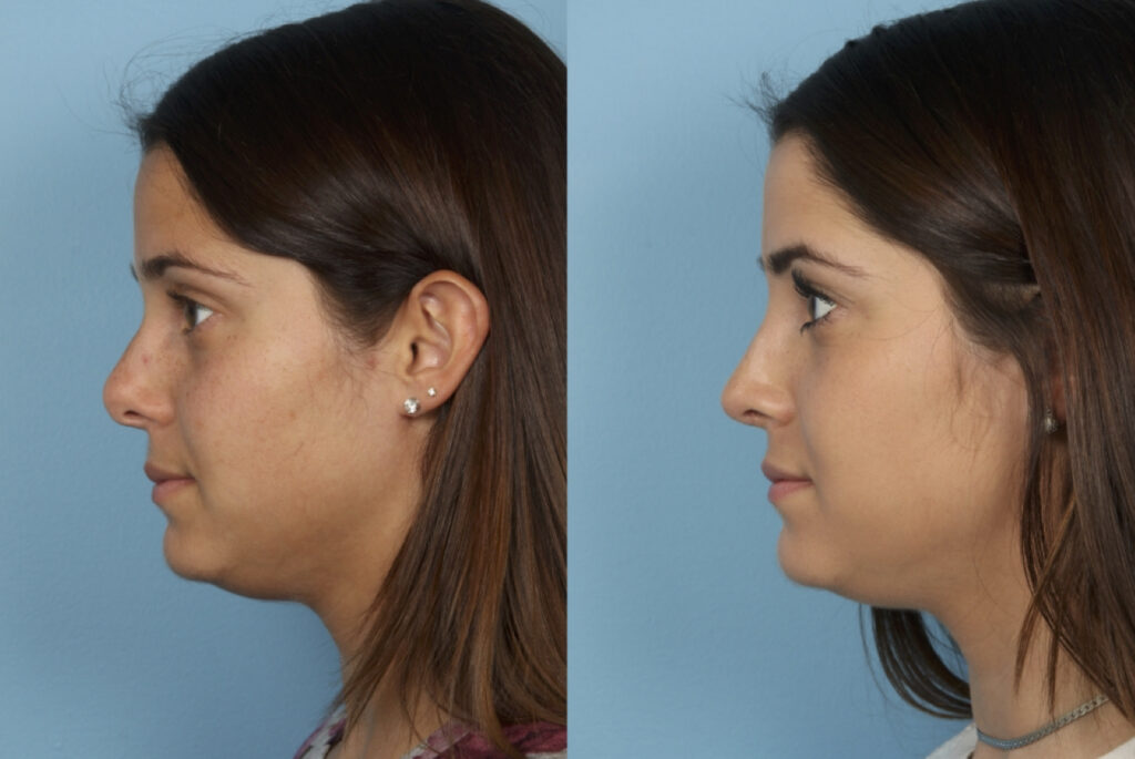 Revision Rhinoplasty